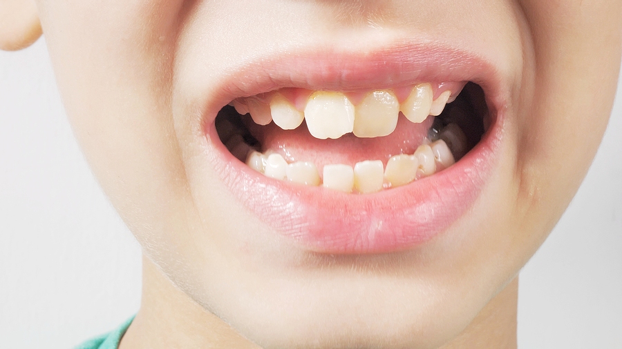 Understanding Pulpotomy: When is it Necessary for Your Child?